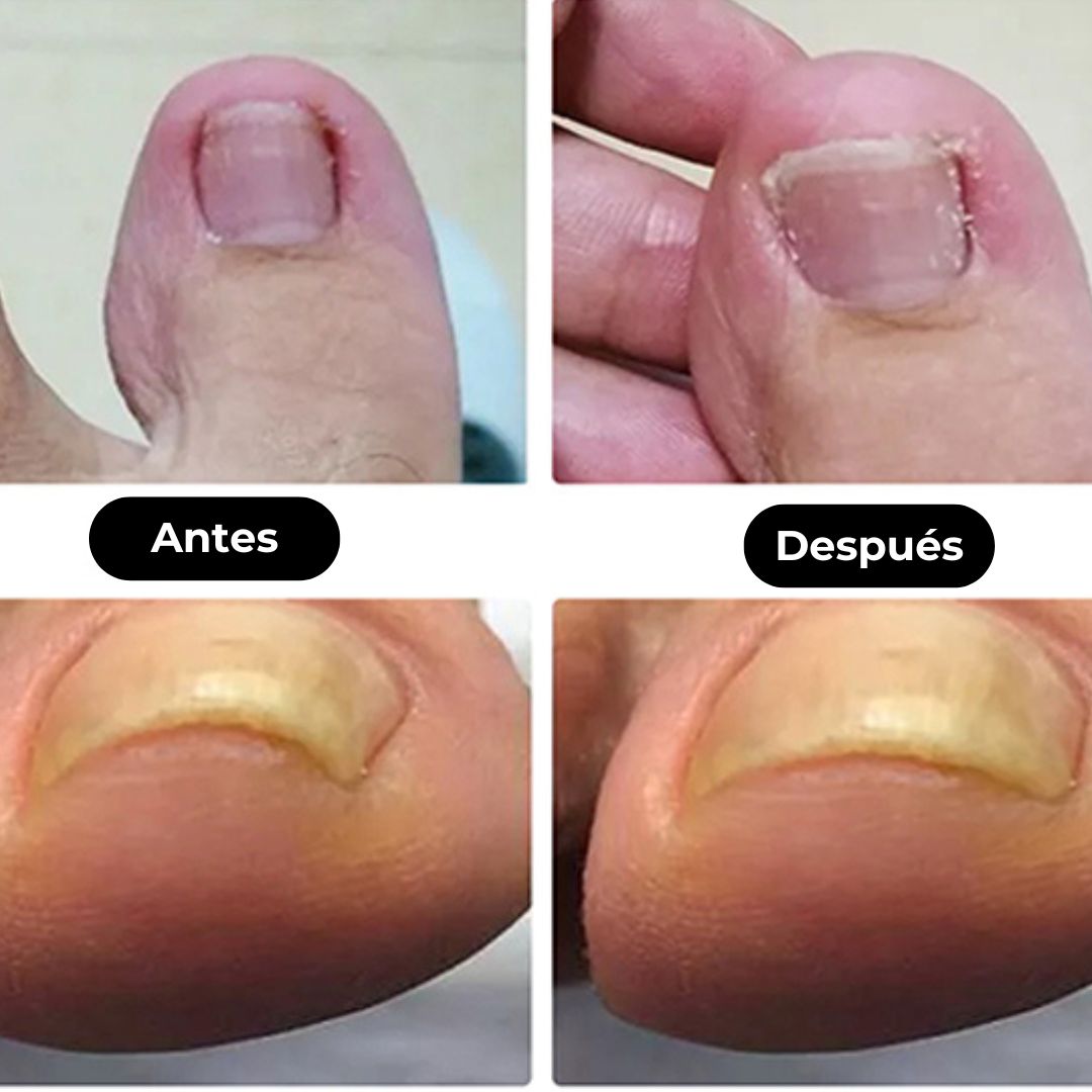 Aceite anti hongos